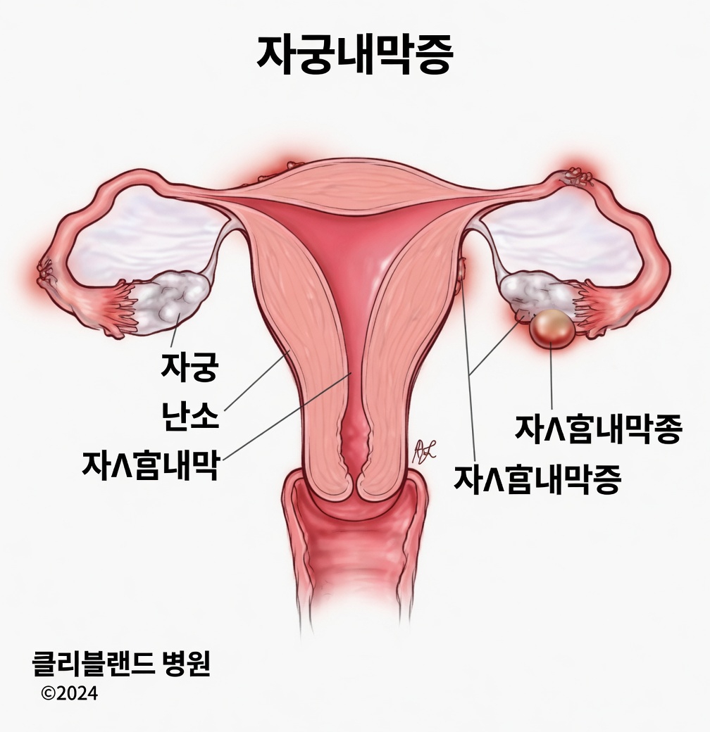 자궁내막증이란 무엇이며 왜 모든 여성이 이에 대해 알아야 할까요?