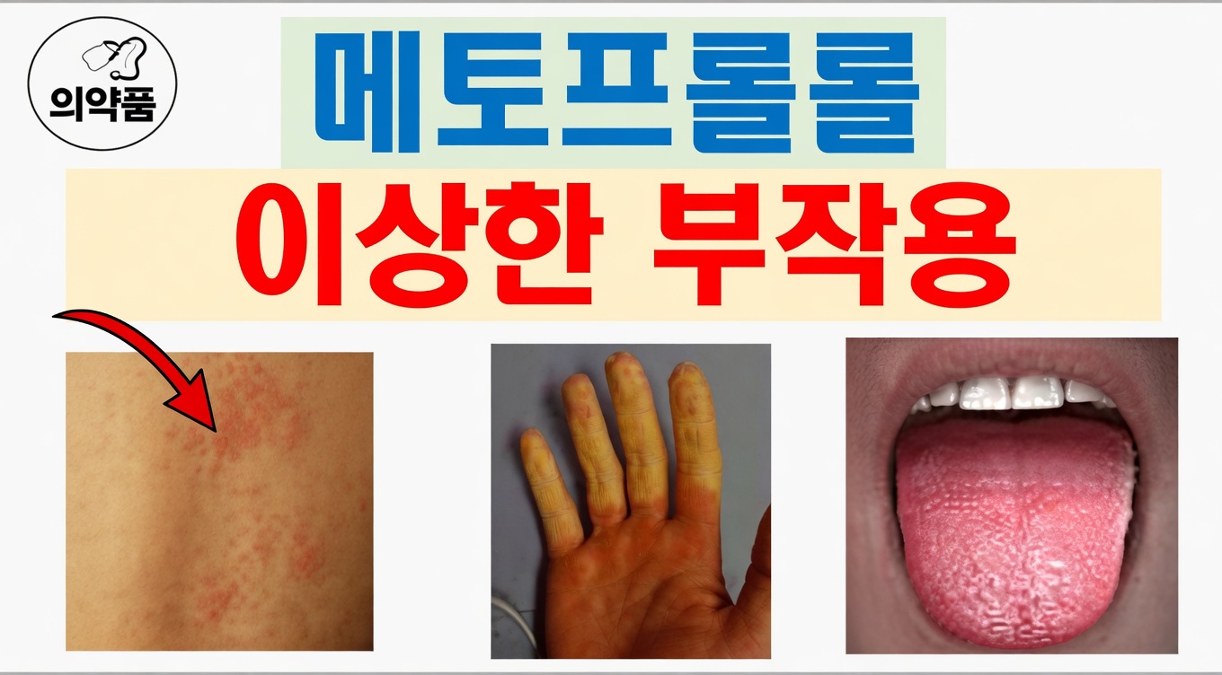 메토프롤롤의 흔한 10가지 부작용은 무엇이며, 이를 초기에 어떻게 알아차릴 수 있을까요?