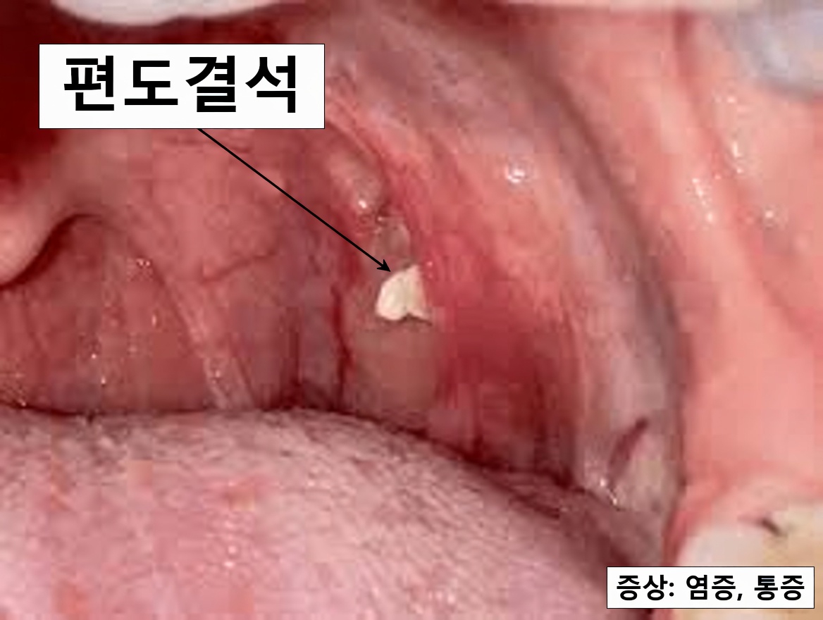 재채기한 뒤 목에서 나온 작은 덩어리는 무엇일까? 편도결석 이해하기