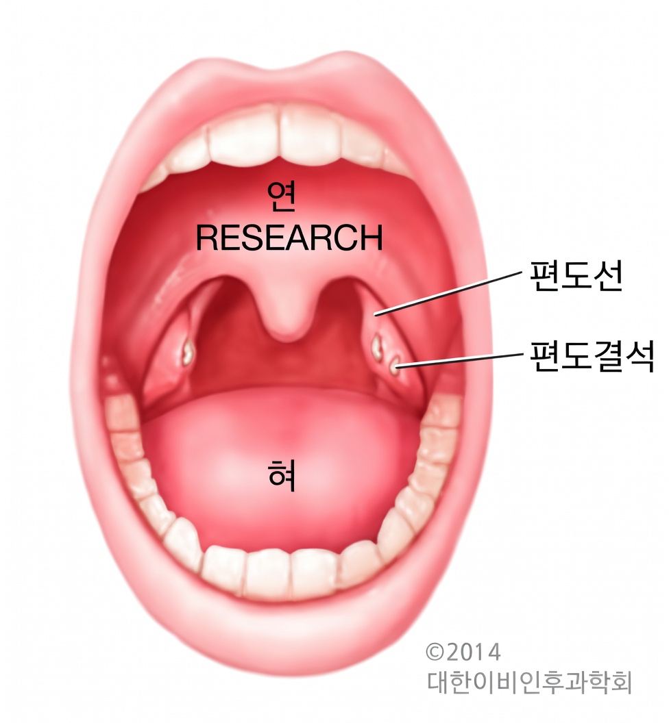 재채기한 뒤 목에서 나온 작은 덩어리는 무엇일까? 편도결석 이해하기