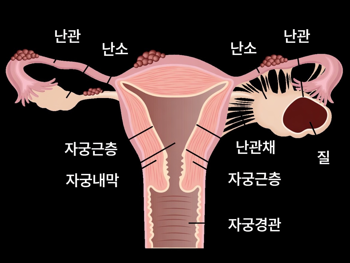 자궁내막증 경고: 절대 무시해서는 안 되는 일상 습관