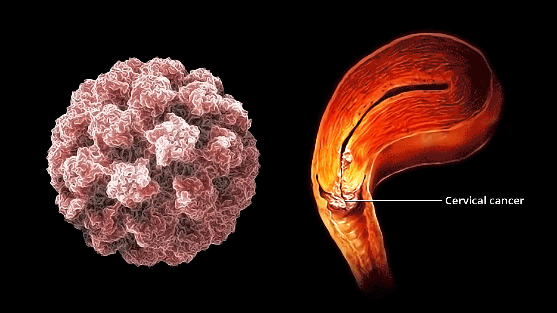 모든 여성이 반드시 알고 절대 무시해서는 안 되는 자궁경부암의 치명적인 증상들