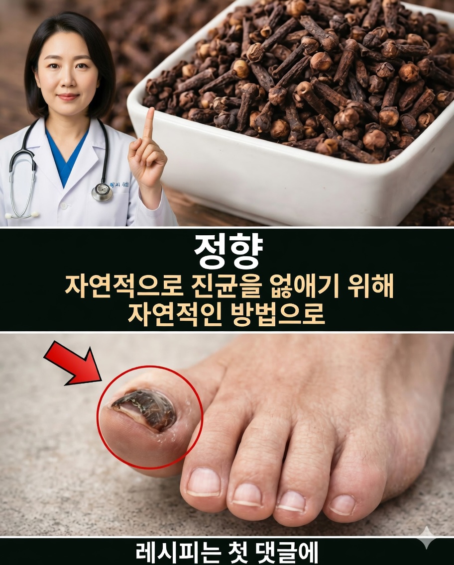 정향으로 손발톱 무좀 제거하기: 점점 더 많은 사람이 선택하는 천연 치료법