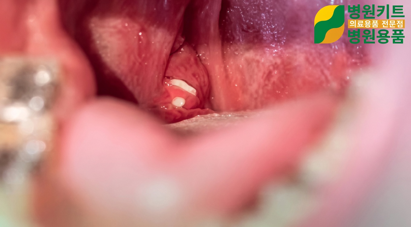 편도결석: 무엇이며 왜 지속적인 입 냄새의 원인일 수 있는지