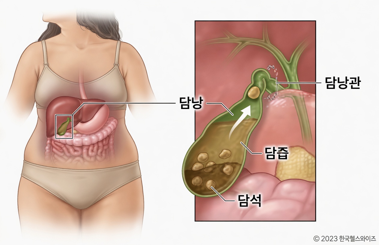 담낭의 편안함에 도움이 될 수 있는 일상 습관 두 가지 발견하기