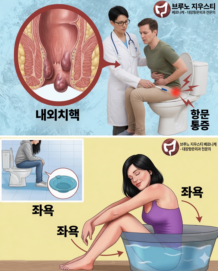 치질: 빠르고 자연스럽게 없애는 방법