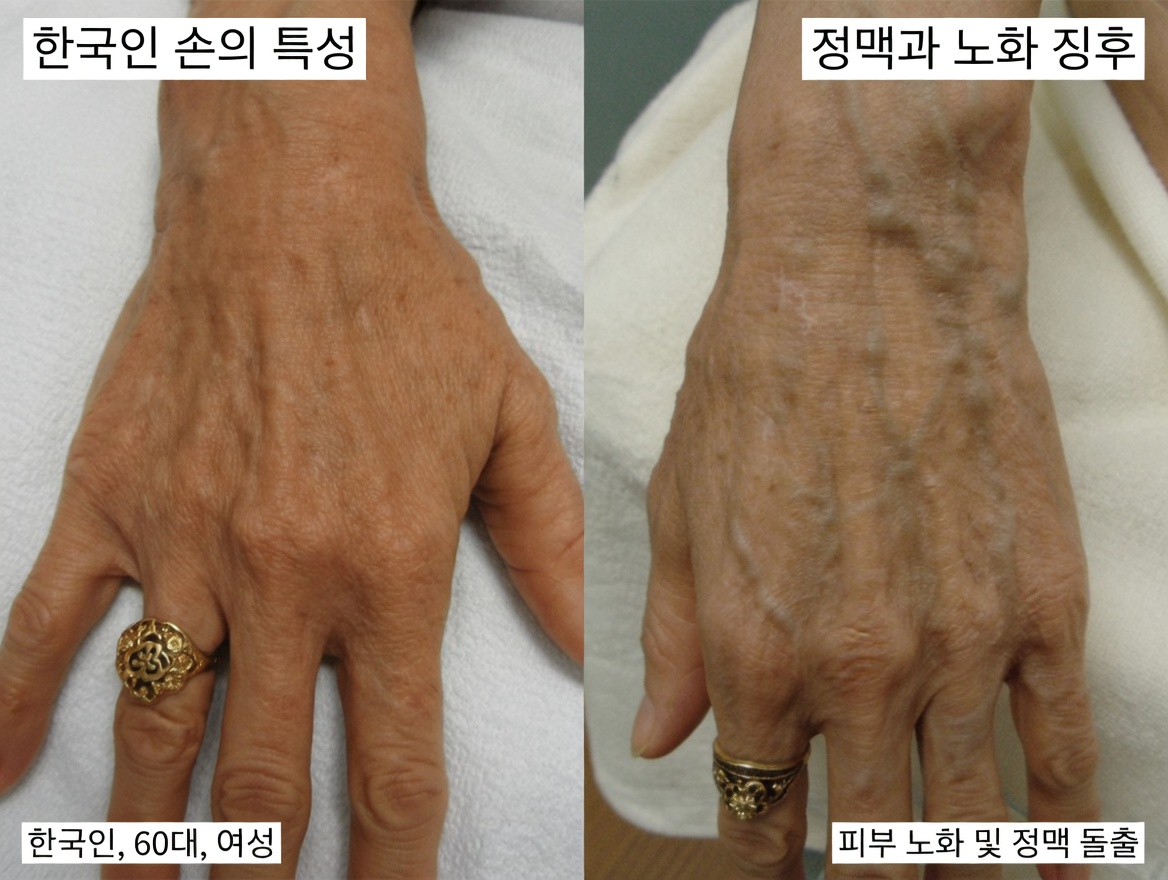 하지정맥류를 없애고 혈액순환을 자연스럽게 개선하는 10가지 천연 방법