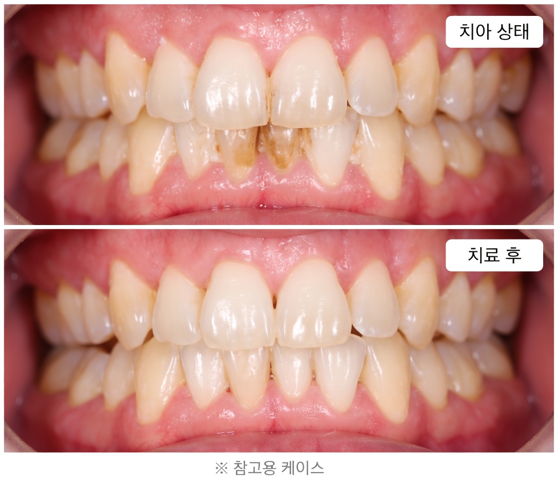 달걀껍질로 단 5분 만에 누런 이를 진주처럼 하얗게