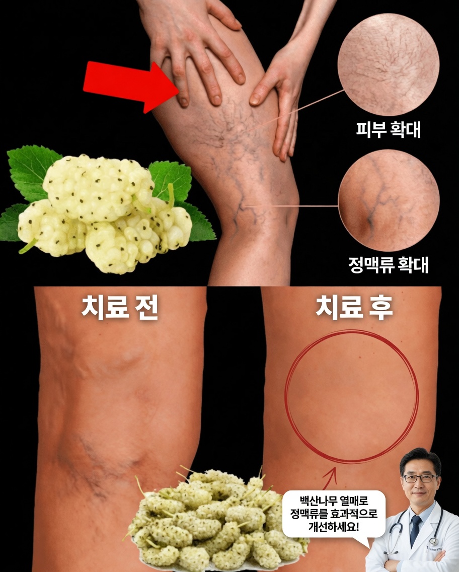 더 건강한 다리를 위한 자연스러운 길: 하지정맥류 완화를 돕는 15가지 방법