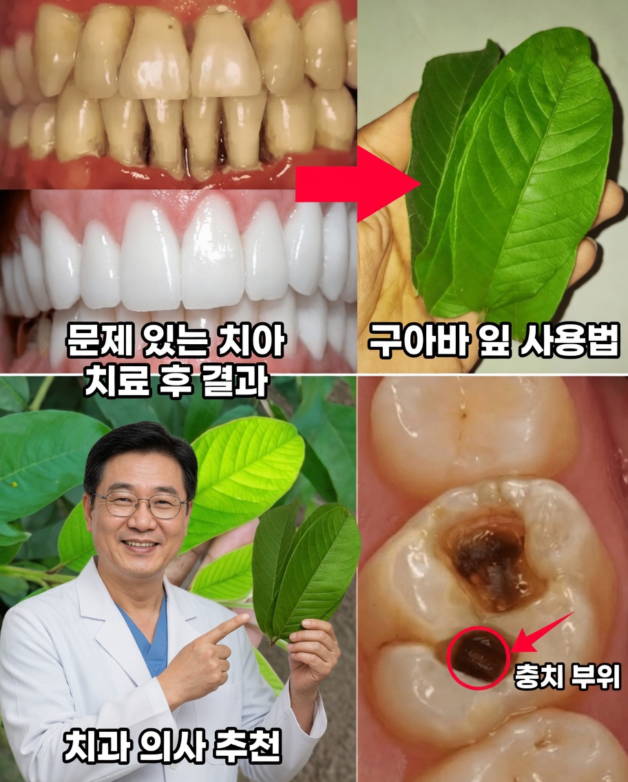 Folhas de Goiaba로 충치를 치료하는 간단하고 경제적인 3가지 방법