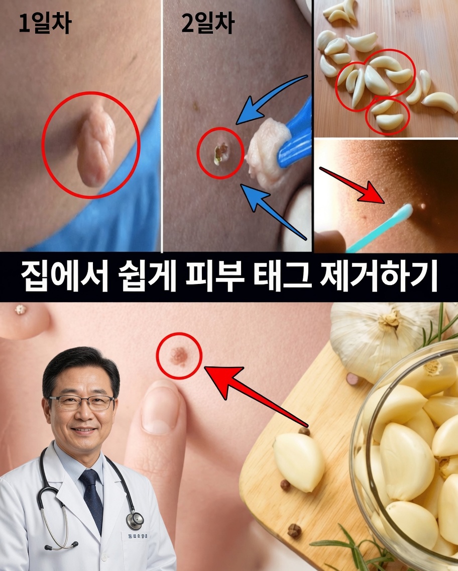 바셀린으로 피부 연성 섬유종을 자연스럽게 제거하는 방법: 간단한 하룻밤 방법