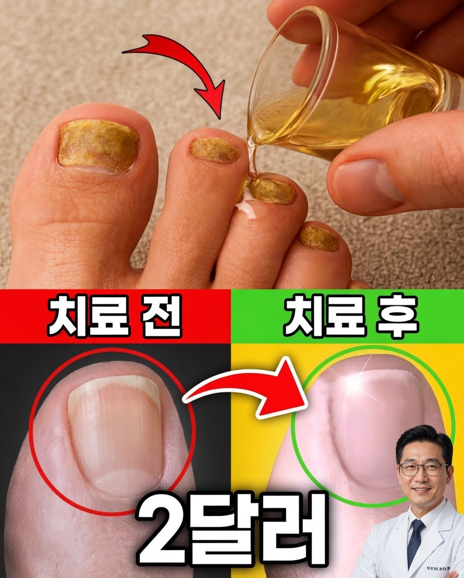손톱 무좀으로 고생하시나요? 이 간단한 천연 담금법을 시도해 보세요